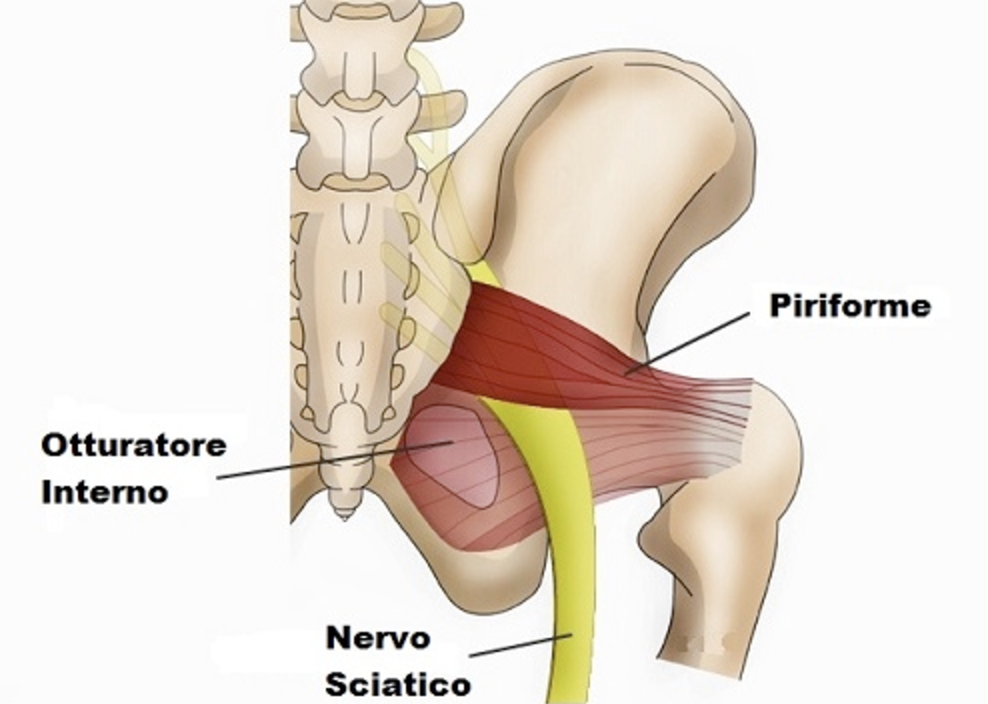 Sindrome del Pirifome: cosa bisogna sapere